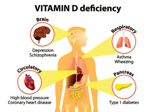 ciri kekurangan vitamin d